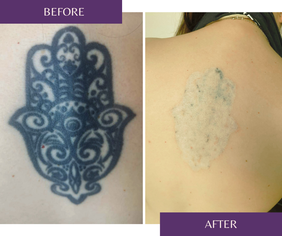Tattoo Removal - Skin Expertise by Annelise